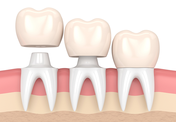 3d-dental-crown-placement-2