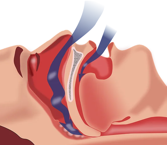 1200px-Obstruction_ventilation_apnée_sommeil.svg 1