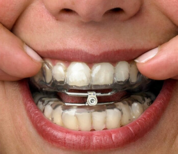 Some-Commonly-Asked-Questions-About-Oral-Appliance-Therapy-e1630769827864 1
