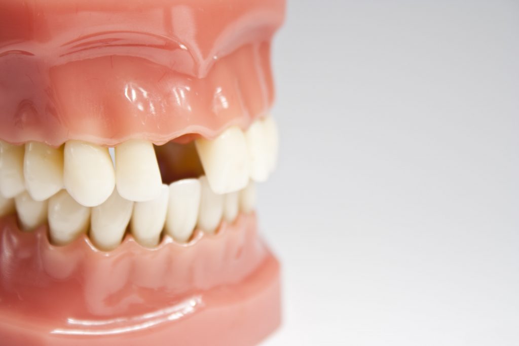 missing-tooth-min-1024x683