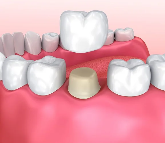 porcelain+crowns 1