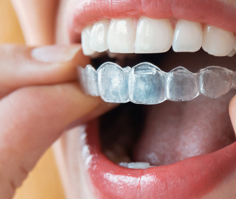 Spring Update Plus Invisalign Day Savings Announcement