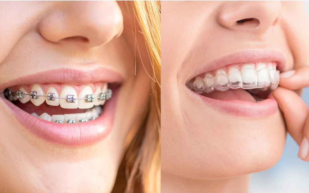 Invisalign vs. Braces: Which Treatment Is Right for You?
